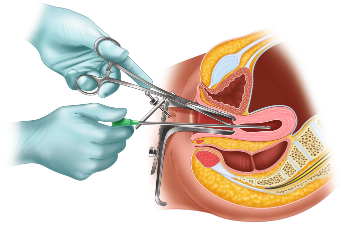 dilation and evacuation abortion procedure